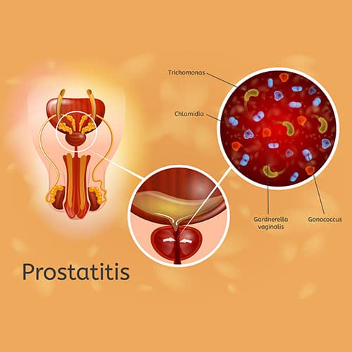 Pain During Urination by Acute Prostatitis: What it is, and How to Book a Consultation Service for Its Treatment Through StrongBody AI