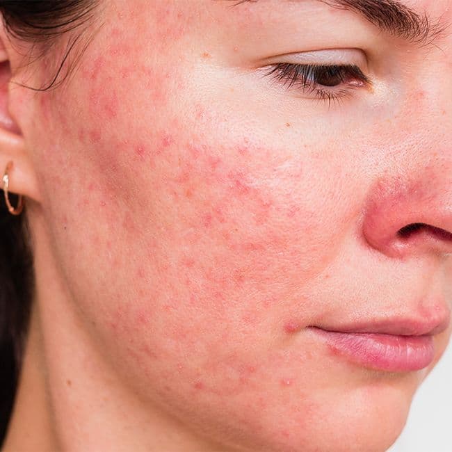 Adult Acne – Effective Solutions