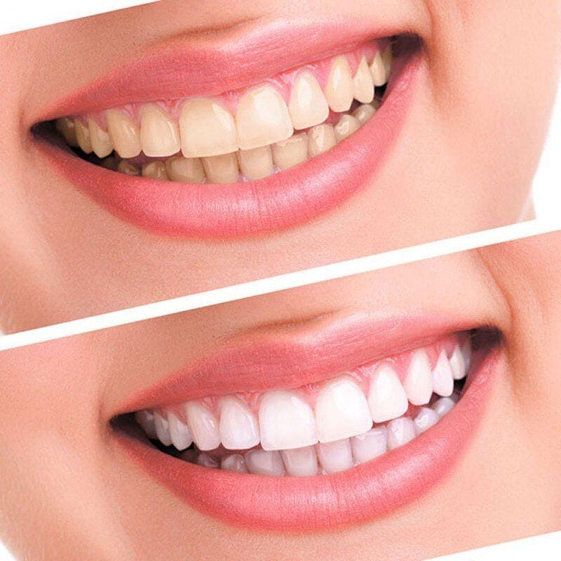 Safe teeth whitening – Fast results thumbnail 2