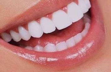 Safe teeth whitening – Fast results thumbnail 3