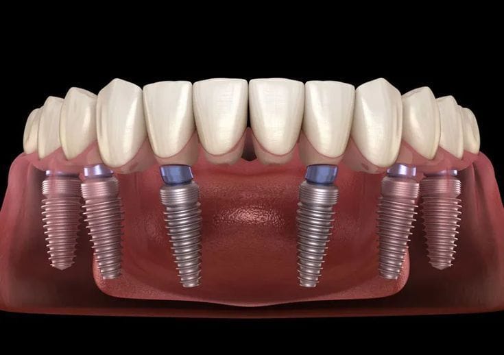 Offline Implant Surgery thumbnail 3