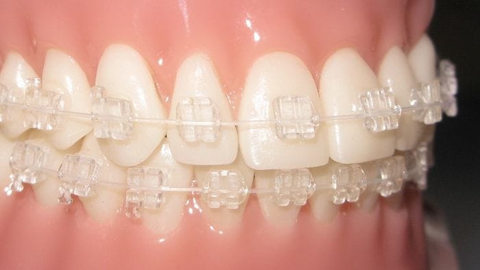 Clear braces thumbnail 3