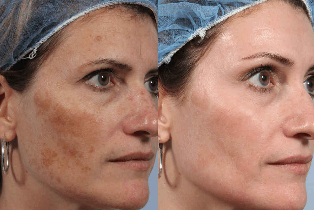🌸DEEP MELASMA CONSULTATION - PERSONALIZED REGIMEN FOR BRIGHT, HEALTHY SKIN🌸
