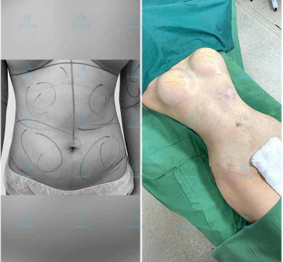 Abdominal Liposuction - Hút Mỡ Bụng
