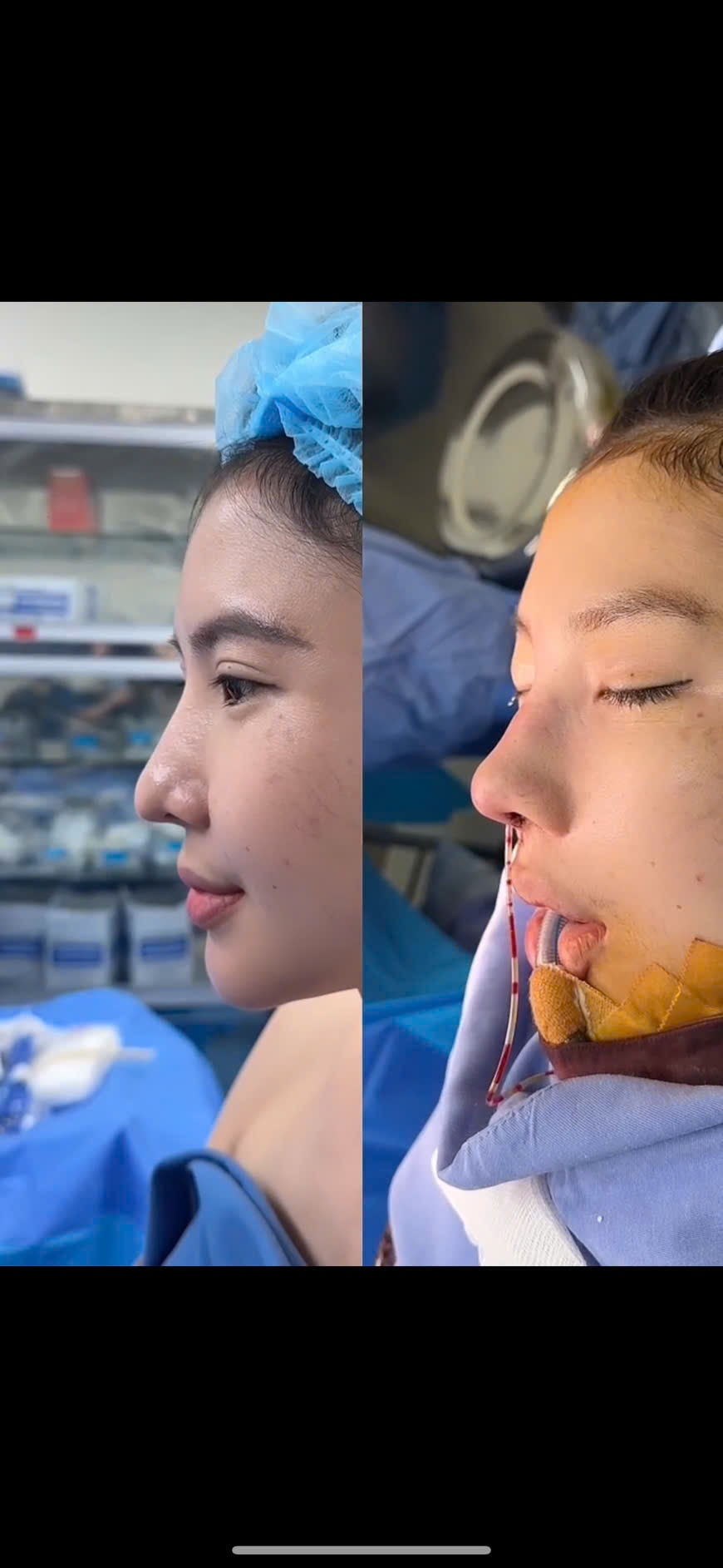Rhinoplasty, Nose Job, Nose Augmentation; nâng mũi, mũi cấu trúc, phẫu thuật nâng mũi, sửa mũi.