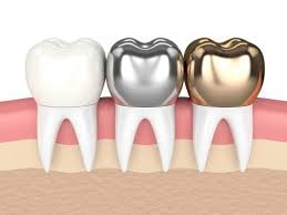 Comprehensive Oral Health Consultation & Artificial Dental Crowns
