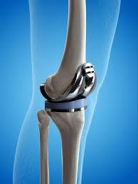 Total Knee Replacement 