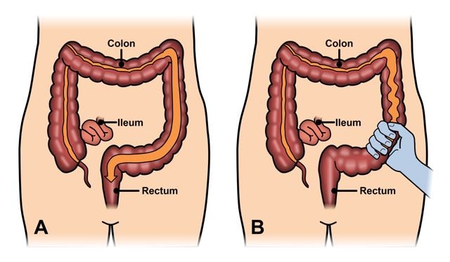 خدمة الاستشارات لإدارة أمراض الأمعاء الالتهابية المزمنة (IBD – داء كرون والتهاب القولون التقرحي)