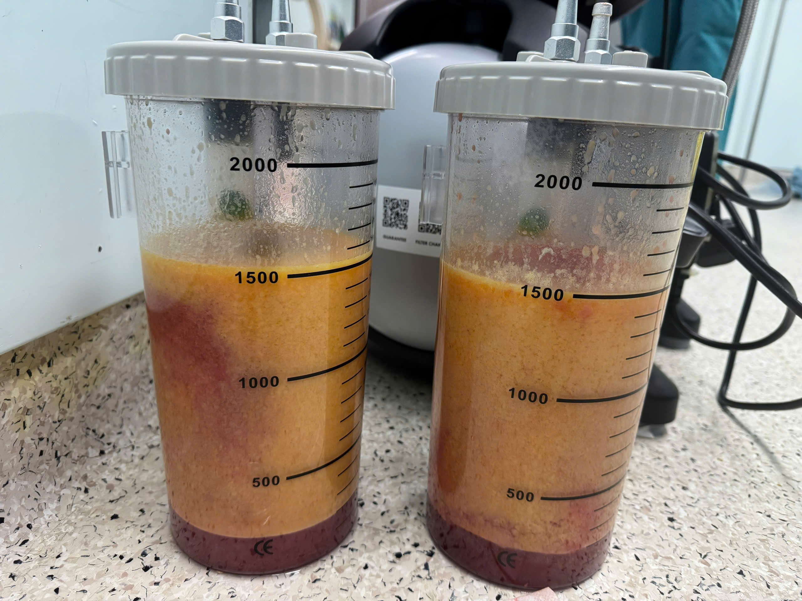 Liposuction, Abdominal Plasty, Abdominal Skin Removal, Tạo hình thành bụng, cắt da bụng, căng da bụng, hút mỡ bụng.